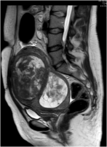 Embolization in myoma
