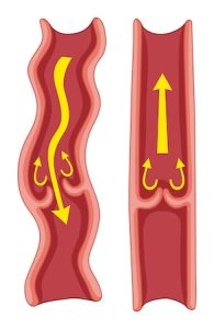 Genital varices