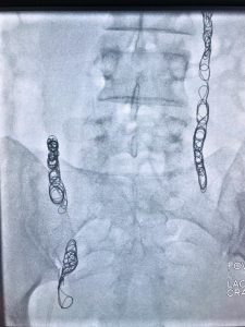 Genital varices
