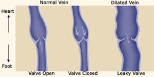 Non-surgical treatment of varicose veins