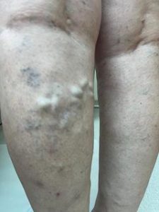 Non-surgical treatment of varicose veins