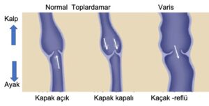Varis Tedavisi