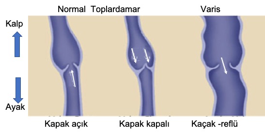 venöz yetmezlik