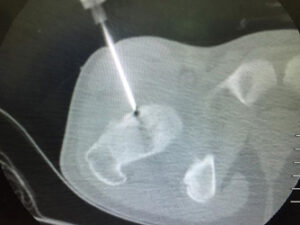 osteoid osteoma ablasyonu