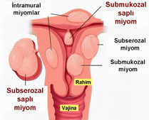Miyom Nedir?