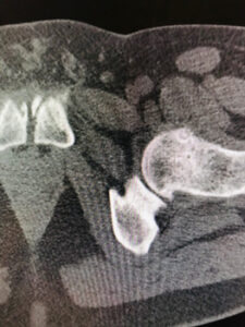 Osteoid Osteoma Ablasyonu