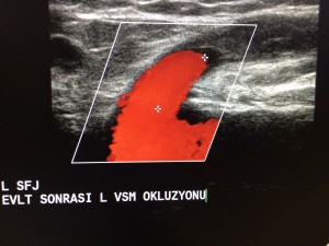 Varisin termal tedavisi