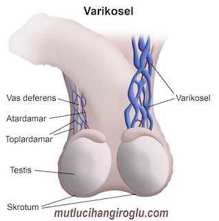 Varikosel Tedavisi