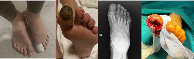 Diyabetik Ayakta Osteomiyelit