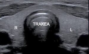 TIRADS Nedir?