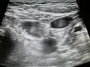 Paratiroid Adenomu Ablasyonu